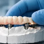 estructuras sobre implantes que no ajustan