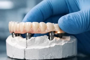 estructuras sobre implantes que no ajustan
