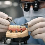 pasividad en implantes