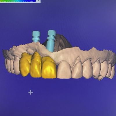 Protesis sobre implantes